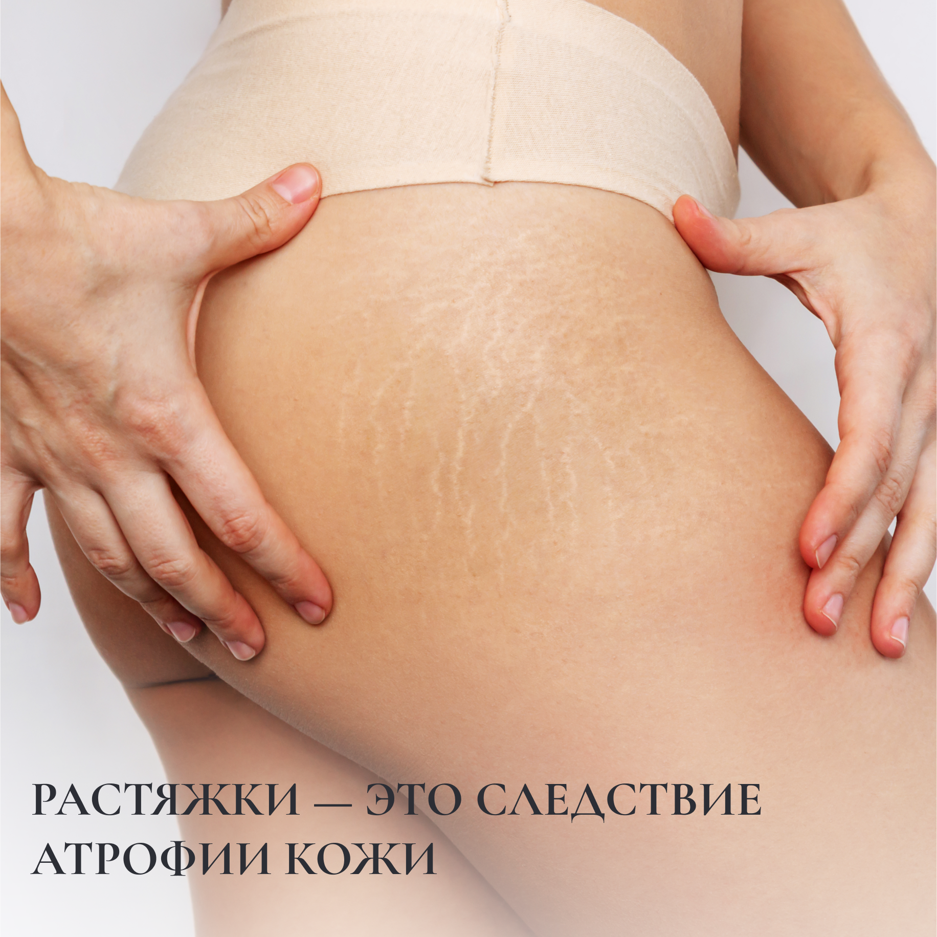 РАСТЯЖКИ — ЭТО СЛЕДСТВИЕ АТРОФИИ КОЖи